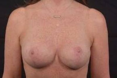 Breast Augmentation Mastopexy Before & After Gallery - Patient 312444 - Image 2