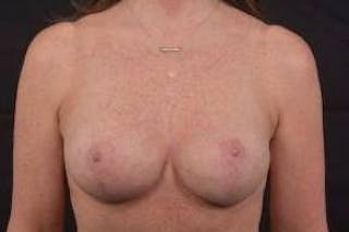 Breast Augmentation Mastopexy Before & After Gallery - Patient 312444 - Image 2