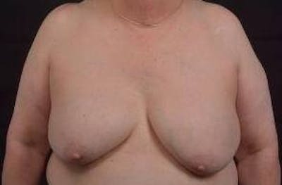 Breast Augmentation Mastopexy Before & After Gallery - Patient 339508 - Image 1