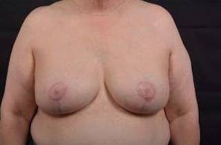 Breast Augmentation Mastopexy Before & After Gallery - Patient 339508 - Image 2