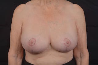 Breast Augmentation Mastopexy Before & After Gallery - Patient 657527 - Image 2