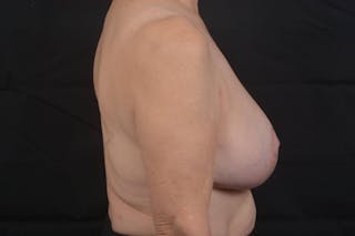 Breast Augmentation Mastopexy Before & After Gallery - Patient 657527 - Image 6