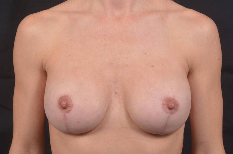 Breast Augmentation Mastopexy Before & After Gallery - Patient 693973 - Image 2
