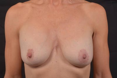 Breast Augmentation Mastopexy Before & After Gallery - Patient 255226 - Image 1