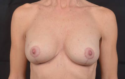 Breast Augmentation Mastopexy Before & After Gallery - Patient 255226 - Image 2