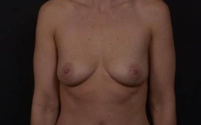 Breast Augmentation Mastopexy Before & After Gallery - Patient 300515 - Image 1
