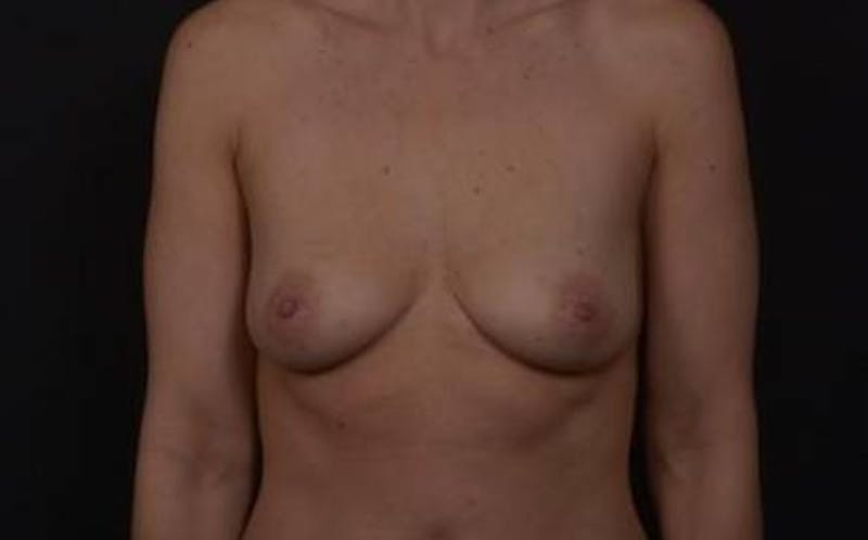 Breast Augmentation Mastopexy Before & After Gallery - Patient 300515 - Image 1
