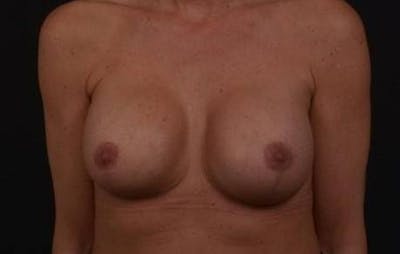 Breast Augmentation Mastopexy Before & After Gallery - Patient 168662 - Image 2