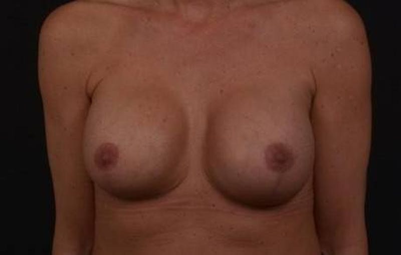 Breast Augmentation Mastopexy Before & After Gallery - Patient 168662 - Image 2