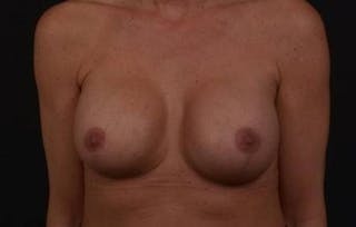 Breast Augmentation Mastopexy Before & After Gallery - Patient 168662 - Image 2
