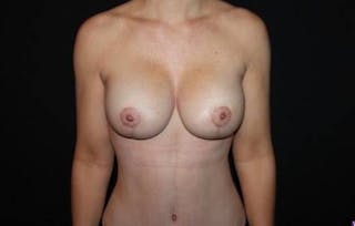 Breast Augmentation Mastopexy Before & After Gallery - Patient 116838 - Image 2