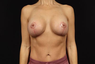 Breast Augmentation Mastopexy Before & After Gallery - Patient 667431 - Image 2