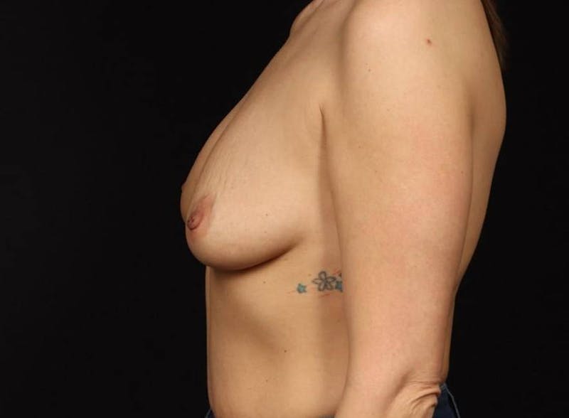 Breast Augmentation Mastopexy Before & After Gallery - Patient 408237 - Image 5