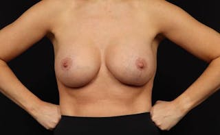 Breast Augmentation Mastopexy Before & After Gallery - Patient 173898 - Image 2
