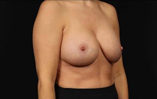 Breast Augmentation Mastopexy Before & After Gallery - Patient 173898 - Image 8