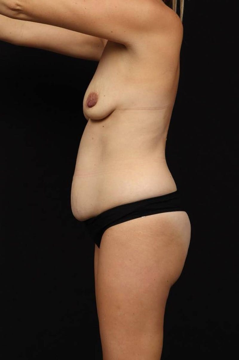 Breast Augmentation Mastopexy Before & After Gallery - Patient 235367 - Image 5