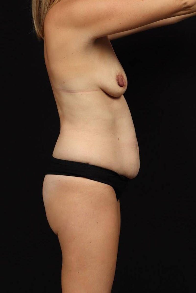 Breast Augmentation Mastopexy Before & After Gallery - Patient 235367 - Image 9