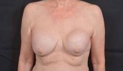 Breast Augmentation Mastopexy Before & After Gallery - Patient 563443 - Image 1