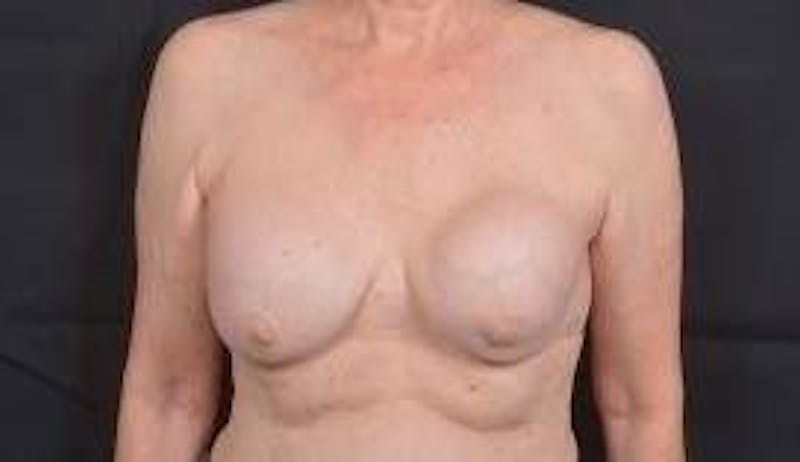 Breast Augmentation Mastopexy Before & After Gallery - Patient 563443 - Image 1