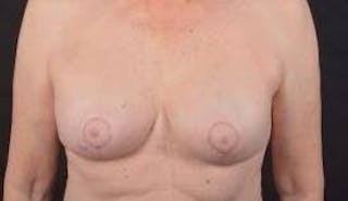 Breast Augmentation Mastopexy Before & After Gallery - Patient 563443 - Image 2
