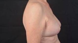 Breast Augmentation Mastopexy Before & After Gallery - Patient 563443 - Image 6