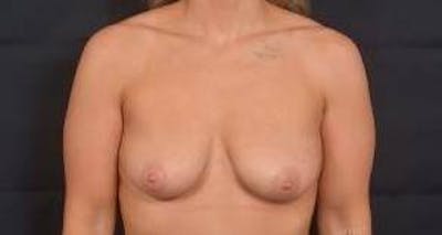 Breast Augmentation Mastopexy Before & After Gallery - Patient 187556 - Image 1