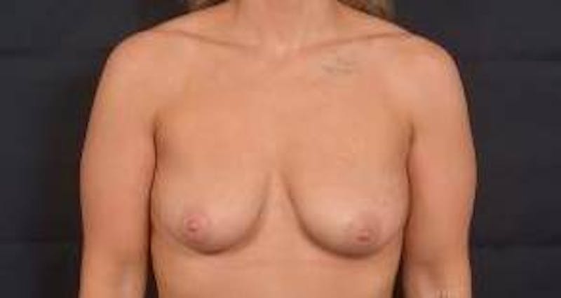 Breast Augmentation Mastopexy Before & After Gallery - Patient 187556 - Image 1
