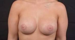 Breast Augmentation Mastopexy Before & After Gallery - Patient 187556 - Image 2