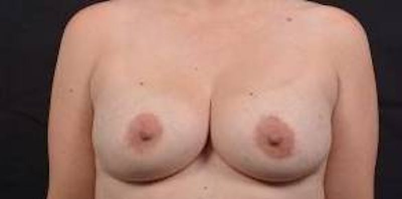 Breast Augmentation Mastopexy Before & After Gallery - Patient 154355 - Image 1