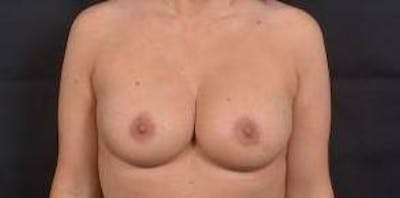 Breast Augmentation Mastopexy Before & After Gallery - Patient 154355 - Image 2