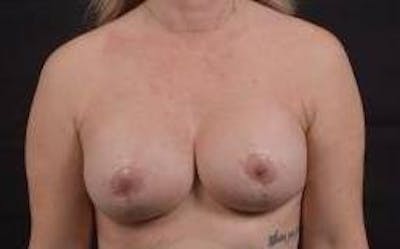 Breast Augmentation Mastopexy Before & After Gallery - Patient 239720 - Image 2
