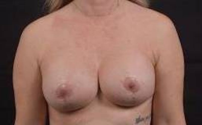 Breast Augmentation Mastopexy Before & After Gallery - Patient 239720 - Image 2