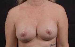 Breast Augmentation Mastopexy Before & After Gallery - Patient 239720 - Image 2