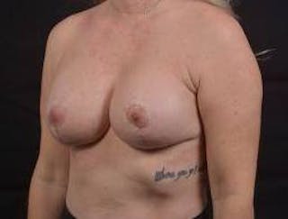 Breast Augmentation Mastopexy Before & After Gallery - Patient 239720 - Image 8