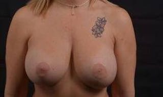 Breast Augmentation Mastopexy Before & After Gallery - Patient 343004 - Image 2