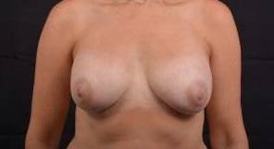 Breast Augmentation Mastopexy Before & After Gallery - Patient 403660 - Image 1