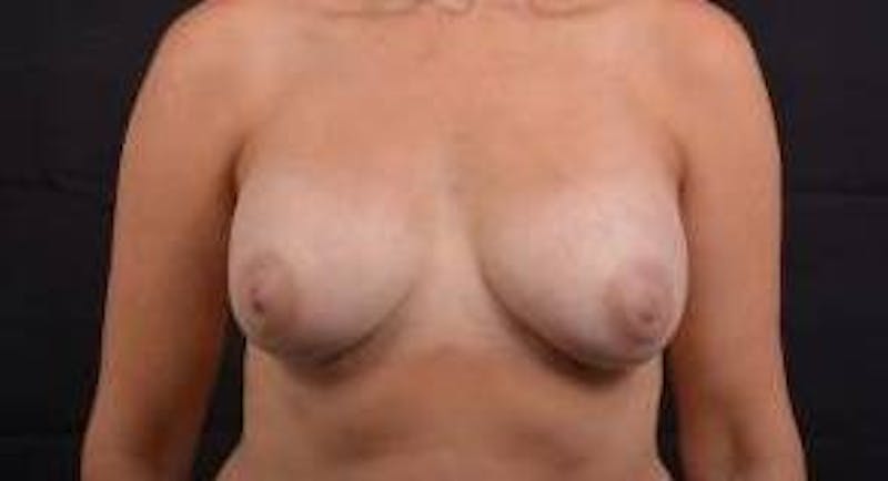 Breast Augmentation Mastopexy Before & After Gallery - Patient 403660 - Image 1