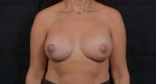 Breast Augmentation Mastopexy Before & After Gallery - Patient 403660 - Image 2