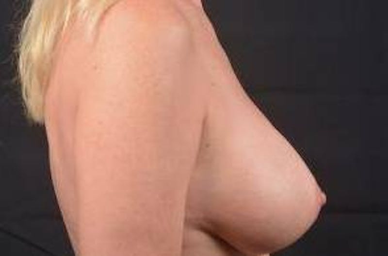 Breast Augmentation Mastopexy Before & After Gallery - Patient 421639 - Image 5