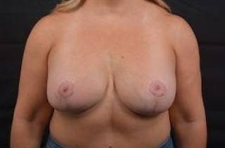 Breast Augmentation Mastopexy Before & After Gallery - Patient 991469 - Image 2