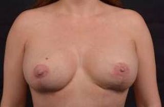 Breast Augmentation Mastopexy Before & After Gallery - Patient 520358 - Image 2