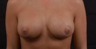 Breast Augmentation Mastopexy Before & After Gallery - Patient 216324 - Image 2