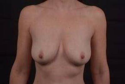 Breast Augmentation Mastopexy Before & After Gallery - Patient 338371 - Image 1