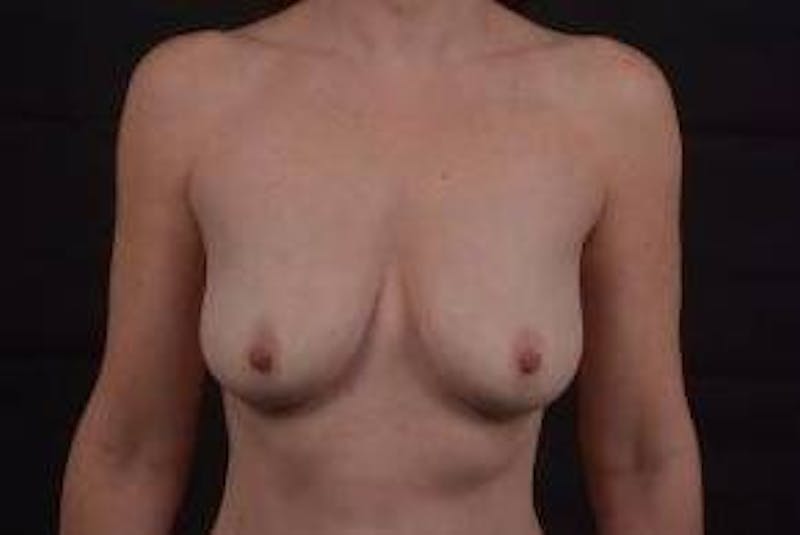 Breast Augmentation Mastopexy Before & After Gallery - Patient 338371 - Image 1