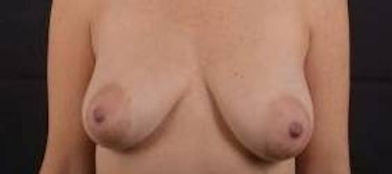 Breast Augmentation Mastopexy Before & After Gallery - Patient 371962 - Image 1