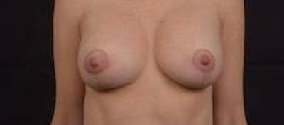 Breast Augmentation Mastopexy Before & After Gallery - Patient 371962 - Image 2