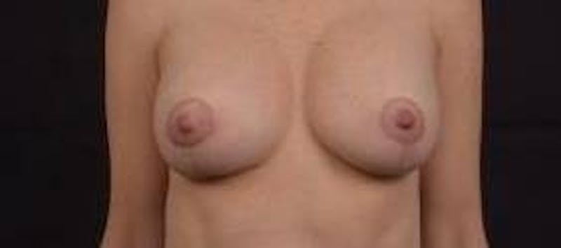 Breast Augmentation Mastopexy Before & After Gallery - Patient 371962 - Image 2
