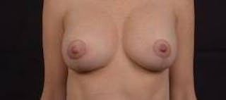 Breast Augmentation Mastopexy Before & After Gallery - Patient 371962 - Image 2