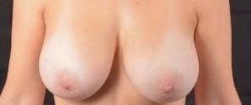 Breast Augmentation Mastopexy Before & After Gallery - Patient 635775 - Image 1
