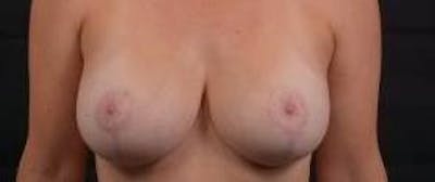 Breast Augmentation Mastopexy Before & After Gallery - Patient 635775 - Image 2